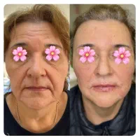 مرکز تخصصی خدمات ژل لب و بوتاکس فیلر بادی،آنزیم