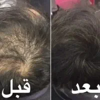 درمان ریزش مو با اگزو سرم به طور دائم