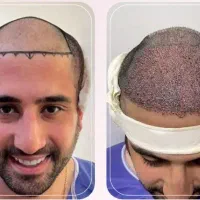 تخفیفات کاشت
