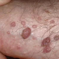 درمان قطعی زگیل hpv و تبخال hsv|خدمات زیبایی و سلامت|کرمانشاه, |دیوار