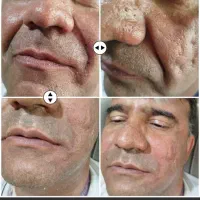 ژل و بوتاکس در منزل شما|خدمات آرایشگری و زیبایی|کرمانشاه, |دیوار