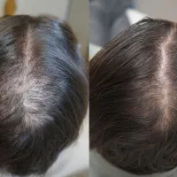 معجزه رویش مجدد موی شما