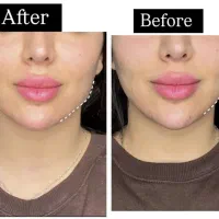 تزریق وآموزش فیلر و بوتاکس|خدمات آموزشی|فردیس, فردیس|دیوار