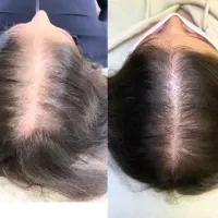 ژل بوتاکس چال لپ فیلربیکینی مزوتراپی پیرسینگ|خدمات آرایشگری و زیبایی|اسلام‌شهر, زرافشان|دیوار