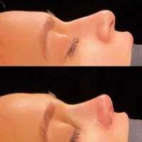 جراحی بینی/انحراف/ مشکلات تنفسی توسط متخصص