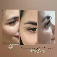 هایفو واژینال،صورت،رفع لک با لیزر کیوسوئیچ|خدمات آرایشگری و زیبایی|گرگان, |دیوار