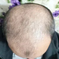 رشد مجدد رفع مشکلات پوستی و ریزش و خودایمنی