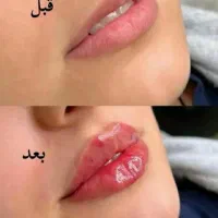 تخفیف 50 درصدی تزریق ژل و بوتاکس|خدمات آرایشگری و زیبایی|ارومیه, |دیوار