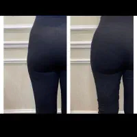 تزریق چربی و فیلر فقط ۷۰۰ هزار