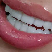 تخفیف ویژه کامپوزیت زیبایی و دندانپزشکی|خدمات آرایشگری و زیبایی|کرج, شاهین‌ویلا|دیوار