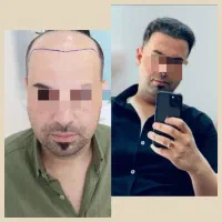 میخوای تضمینی باهزینه کمتر درشهر خودت کاشت مو کنی|خدمات آرایشگری و زیبایی|یزد, |دیوار