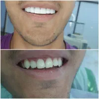 کامپوزیت دندان فقط ۷ میلیون در تهران|خدمات آرایشگری و زیبایی|قم, سالاریه|دیوار