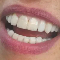 لبخند طلایی با دندون طلا