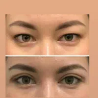 بلفاروپلاستی