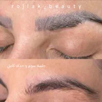 پاک کردن تتو و خالکوبی با لیزر کیوسوییچ پیکوشور|خدمات آرایشگری و زیبایی|مشهد, فرودگاه|دیوار