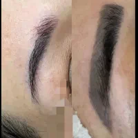 لیزر تتو های بد رنگ و قدیمی ویژه بانوان