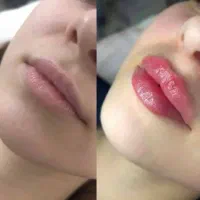 فیلر بوتاکس فیشال هایفو لیزر
