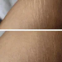 کربوکسی تراپی