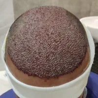 کاشت مو و ابرو و ریش در اردبیل اقساطی و تضمینی