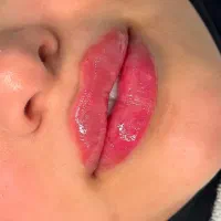 جشنواره ژل و بوتاکس با قیمت باورنکردنی/اقساط|خدمات آرایشگری و زیبایی|آمل, |دیوار