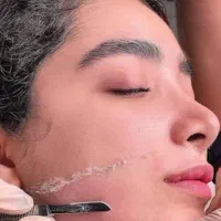 درماپلنینگ صورت رفع موهای کرکی و لایه های شاخی568