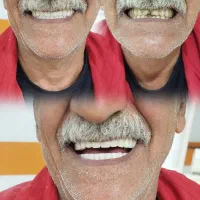 جشنواره دندان مصنوعی خارجی ژله ای با بیمه وضمانت