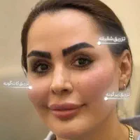 تزریق ژل و بوتاکس چربی