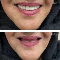 دندان مصنوعی با تعرفه دولتی و اقساط|خدمات آرایشگری و زیبایی|پرند, فاز ۵|دیوار