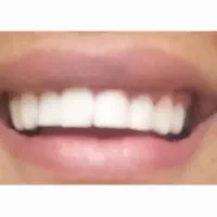 تخفیفات کامپوزیت دندان تا آخر ماه مبارک رجب