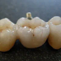 روکش چند واحدی دندان