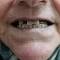 دندان مصنوعی با قیمت اقتصادی و تحویل سریع|پزشکی|رشت, معلولین|دیوار
