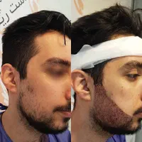 کاشت مو.ابرو.ریش درکیلنیک تخصصی|خدمات آرایشگری و زیبایی|قم, باجک دو|دیوار
