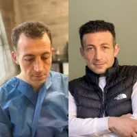 کاشت مو و ابرو با پیش پرداخت ۲تومن|خدمات زیبایی و سلامت|تبریز, |دیوار