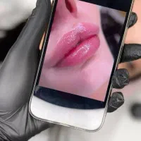 فقط با ۶۰۰هزارتومان. بالن وبوتاکس معده،ژل و بوتاکس