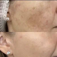 پوست و مو،فیشیال،پلاژن تراپی،مزونیدلینگ،اسیدتراپی