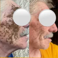 از بین بردن لک و جای جوش فرورفته صورت گچساران