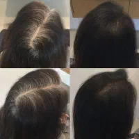 مشاوره ریزش مو