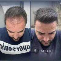 کاشت مو ابرو مژه تزریق مزو