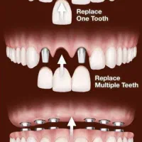 جشنواره ایمپلنت دیجیتال در شیراز|خدمات آرایشگری و زیبایی|جهرم, |دیوار