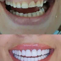 لبخندی رویایی با متریال برند های برتر کامپوزیت|خدمات آرایشگری و زیبایی|یاسوج, |دیوار