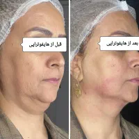 فیشال و مزوتراپی و هایفو