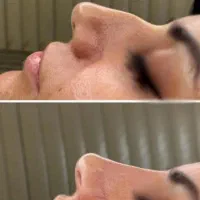 خدمات ژل و بوتاکس پلکسر و...|خدمات آرایشگری و زیبایی|کرمانشاه, |دیوار