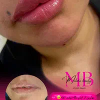 تزریقات ژل‌ لب زاویه فک و بوتاکس با بهترین متریال|خدمات آرایشگری و زیبایی|مشهد, توس (بلوار توس)|دیوار