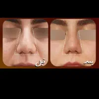 کرم لیفتینگ بینی|آرایشی، بهداشتی، درمانی|رشت, پل تالشان|دیوار