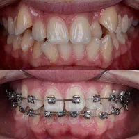 ارتودنسی اقساطی بدون چک معاینه رایگان|خدمات آرایشگری و زیبایی|اندیشه, شهرک صدف|دیوار