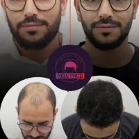 کاشت مو و ابرو توسط متخصصان تهرانی در Ardebil
