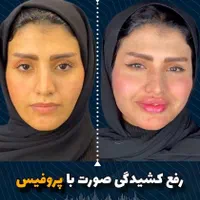 جشنواره کانتورینگ Pro Face بدون جراحی و بیهوشی|خدمات آرایشگری و زیبایی|مشهد, هفت تیر (حافظ)|دیوار