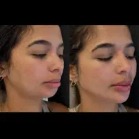 آموزش صفرتا۱۰۰ همه مباحث تزریق فیلر ژل بادی بوتاکس|خدمات آموزشی|شیراز, شریف‌آباد|دیوار