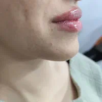 ژل،فیلر لب فقط 590|خدمات آرایشگری و زیبایی|کرج, چهارصد دستگاه|دیوار