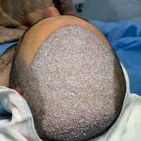 کاشت مو فوق حرفه ای